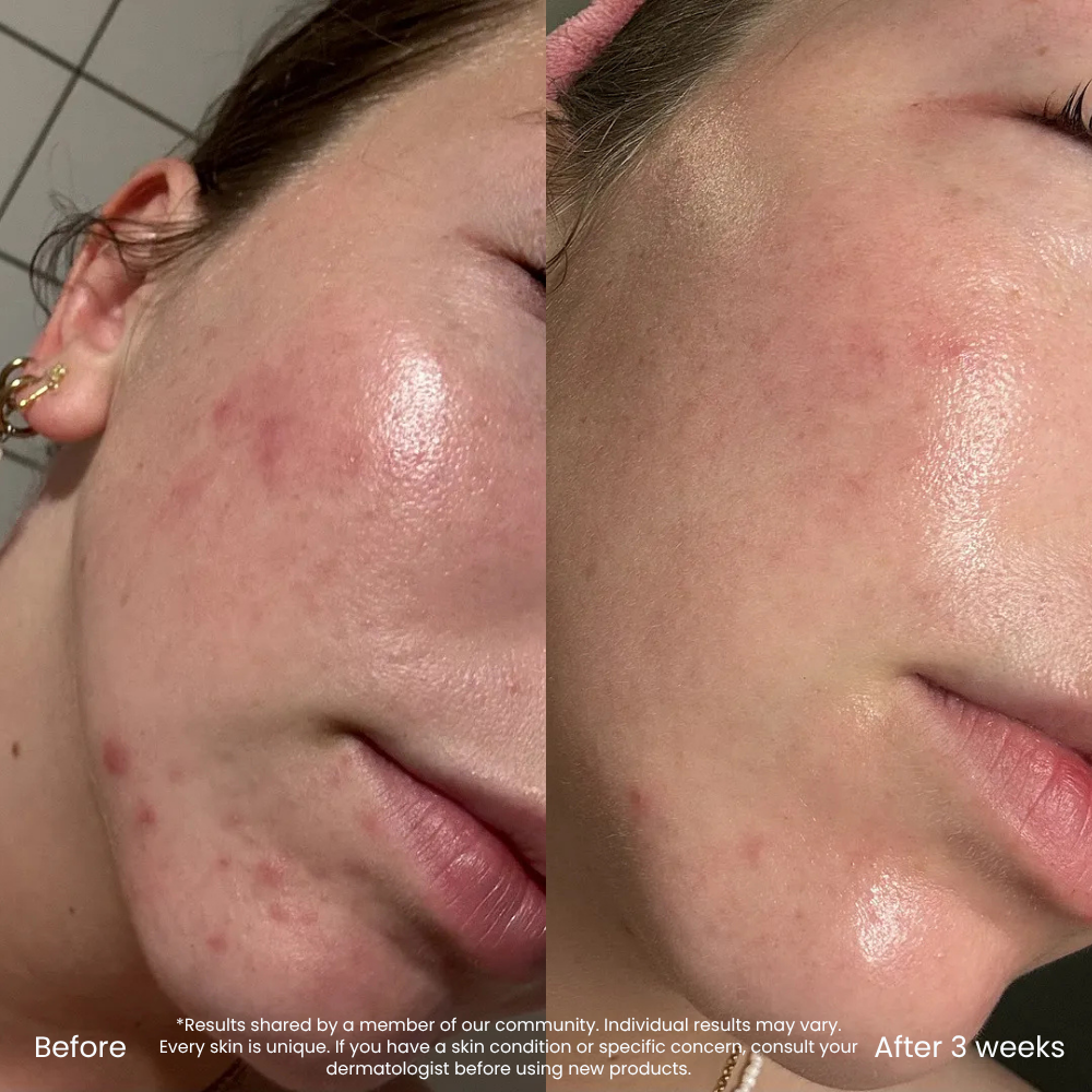 10% Niacinamide Serum Voor Een Zuivere Huid
