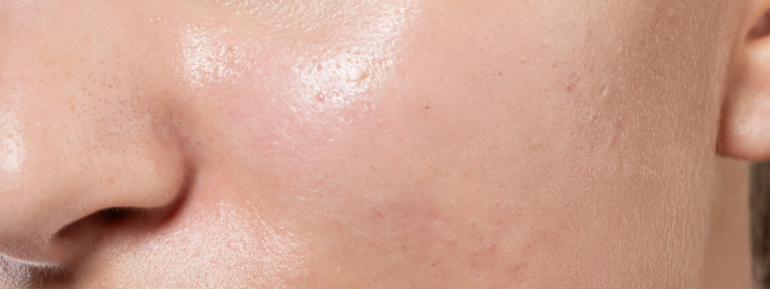 Dry vs. dehydrated skin: What’s the difference & how to treat it