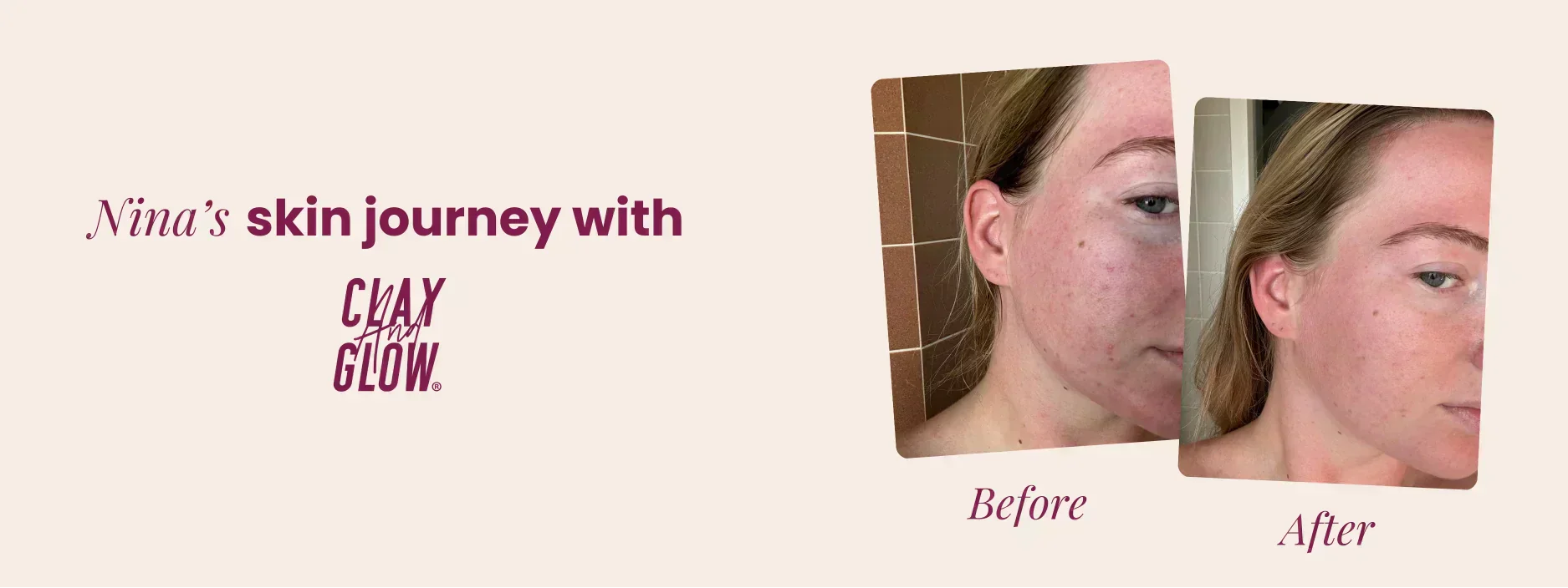 Nina's skin journey with Clay And Glow: From blemishes to a glow