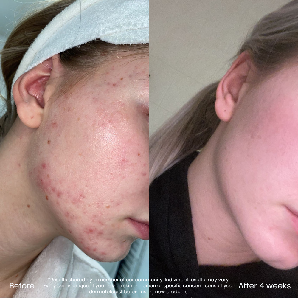 Triple AHA Cleanser voor Onzuiverheden & Een Gladde Huid