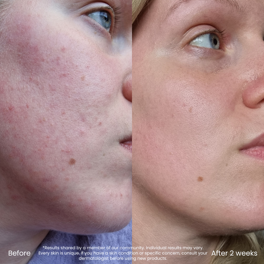 Hyaluronzuur Toner Voor Een Droge & Vochtarme Huid
