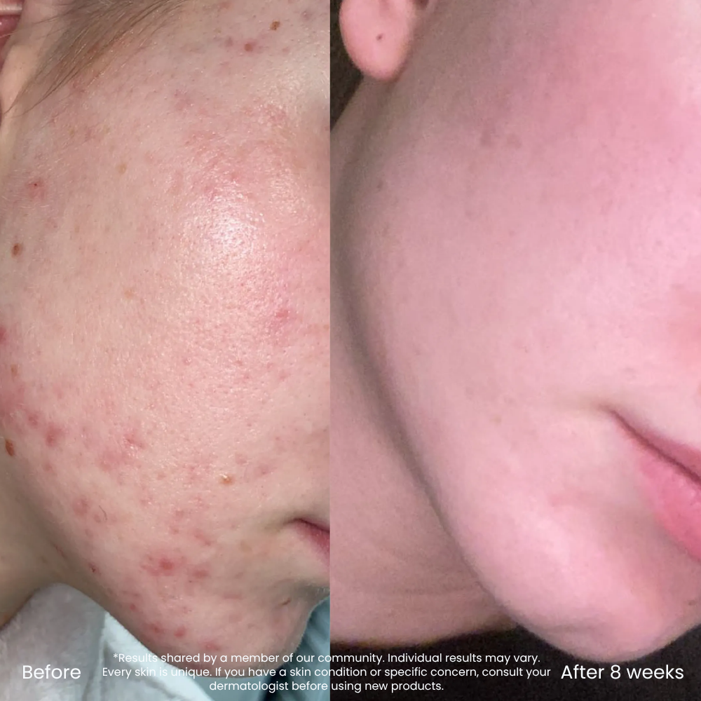 Hyaluronzuur Toner Voor Een Droge & Vochtarme Huid