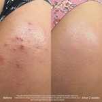 Soothing Body Lotion For Butt Pimples And Bumps