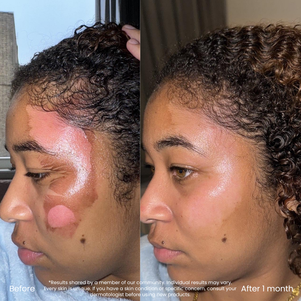 Dark Spot & Redness Correcting Vitamin C Serum